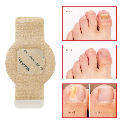 Pansements antifongiques pour ongles
